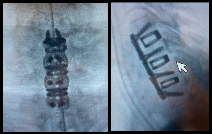 Medtronic ZEVO Plate (Implant 240213)